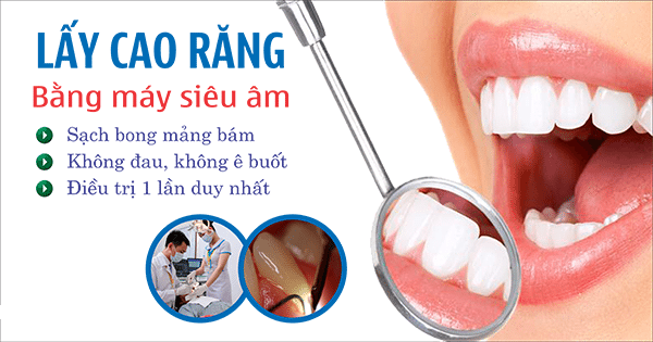 Lấy cao răng